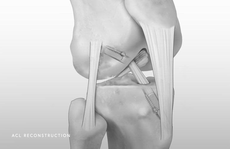 ACL Reconstruction