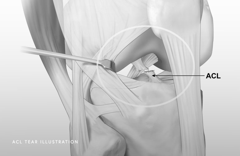 ACL Tear Illustration