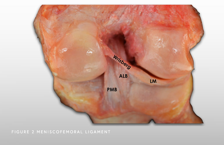 Photo of meniscofemoral ligament