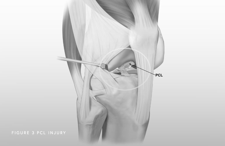 Illustration of a PCL injury
