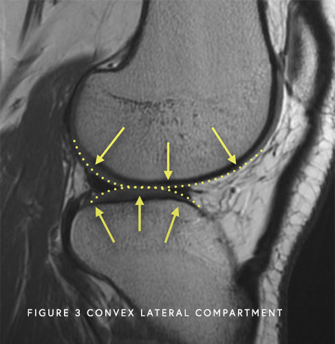 Image of Convex Lateral Compartment