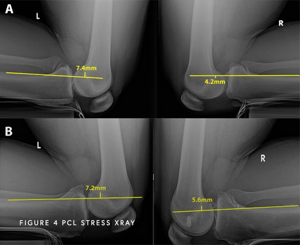 Posterior Cruciate Ligament Pcl Chicago Il Jorge Chahla Md