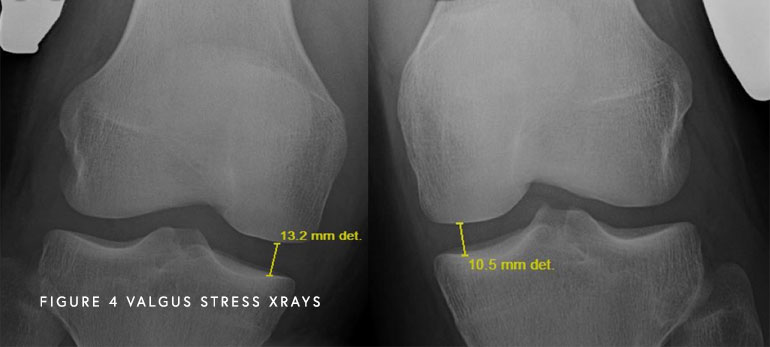 Image of Valgus Stress XRays