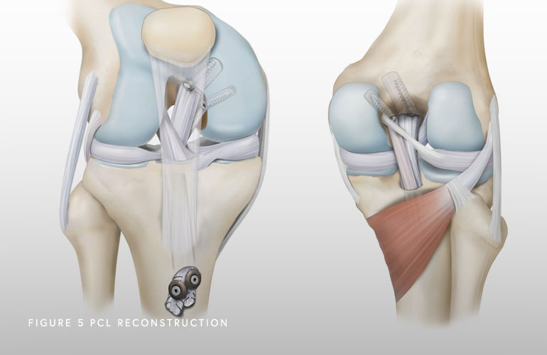 PCL Reconstruction Illustration