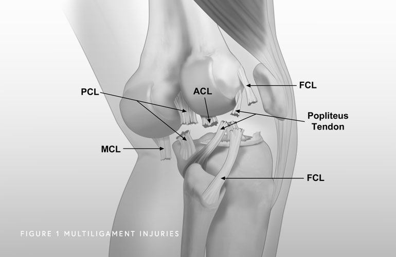 Illustration of multiligament knee injury