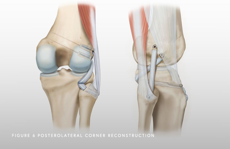 Image of Posterolateral Corner Reconstruction