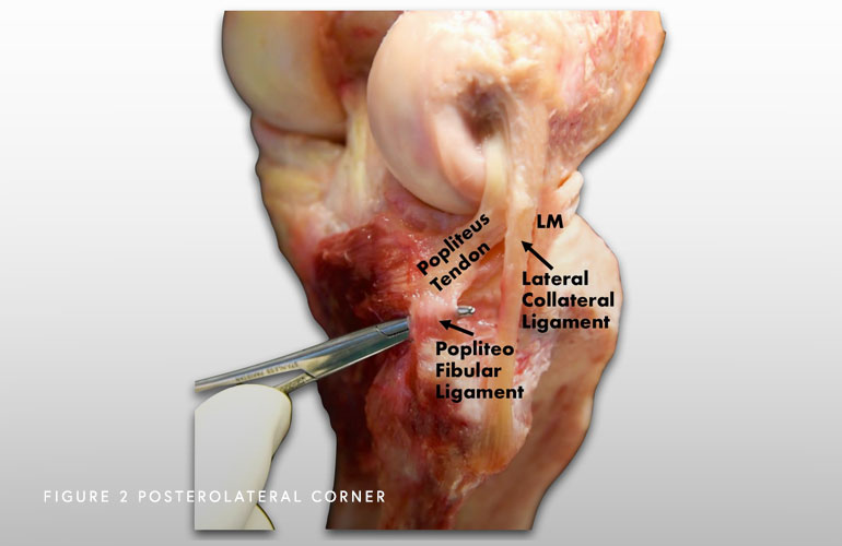 Image of Posterolateral Corner