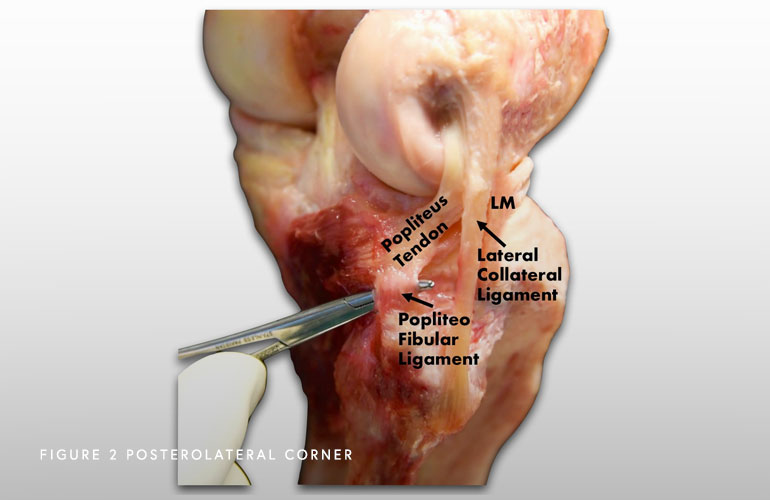 Multi-Ligament Knee Injuries Chicago, IL