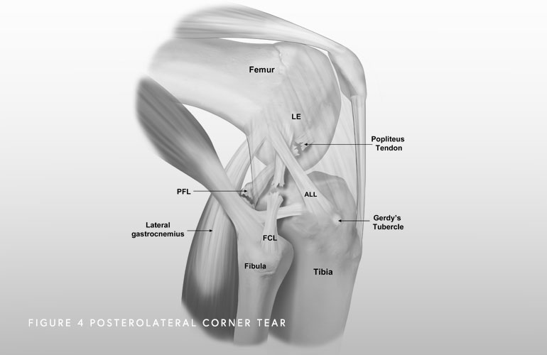 LCL Injury, FCL, Lateral Collateral Ligament, Orthopedic Knee Specialist