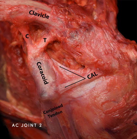 AC Joint Photo