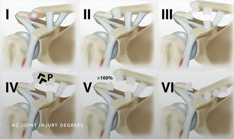 Illustration of AC Joint Injury Degrees