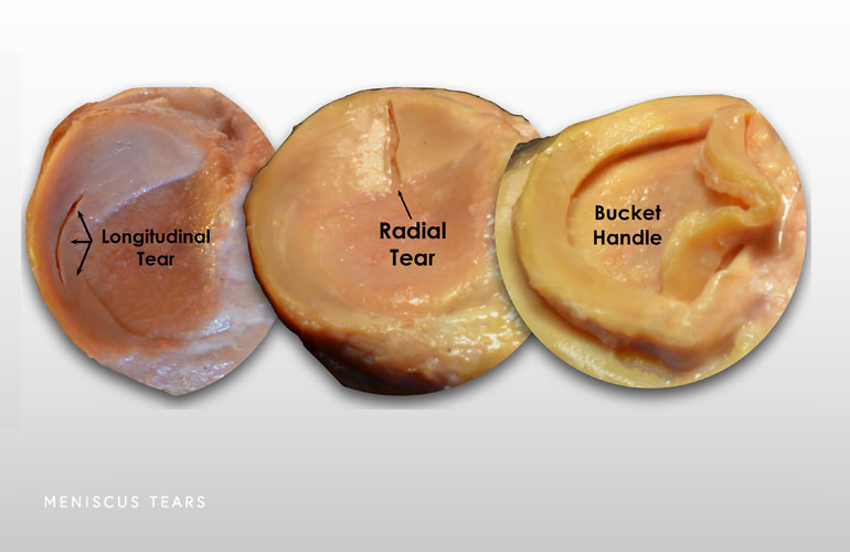 Image of the types of meniscus tears