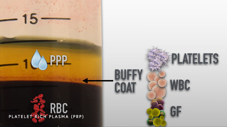 Diagram of Platelet Rich Plasma (PRP)