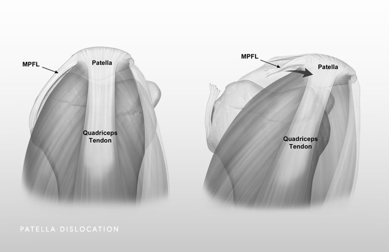 Illustration of patella dislocation