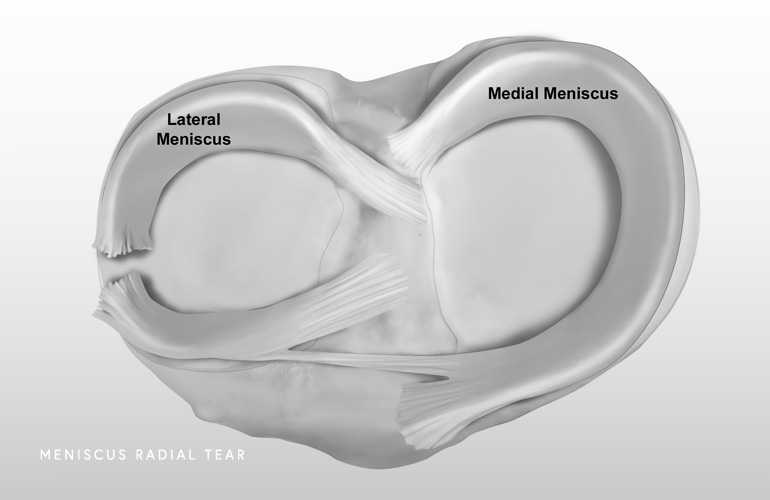 Illustration of a meniscus radial tear