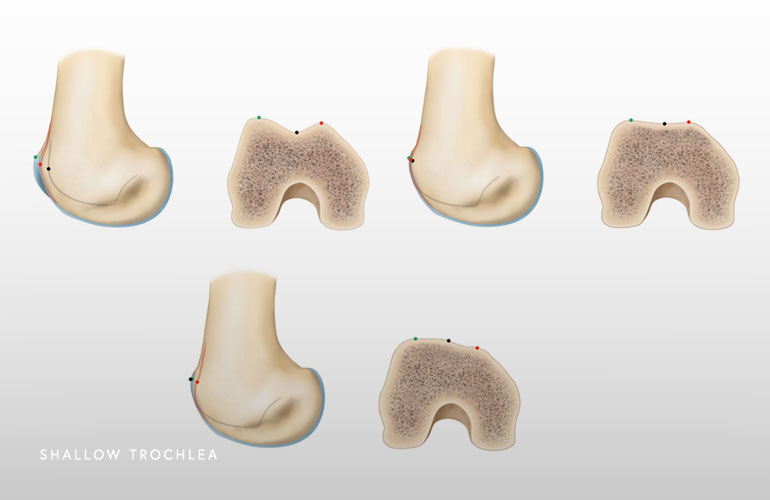 Illustration of shallow trochlea