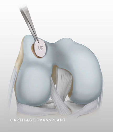 Cartilage Transplant