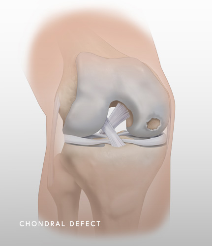 Chondral Defect