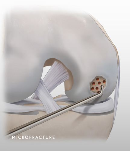 Cartilage Microfracture