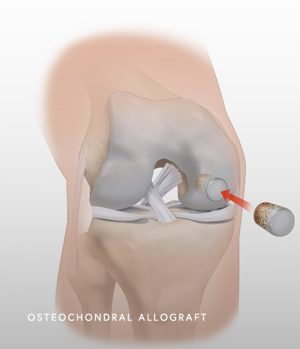 Osteochondral Allograft