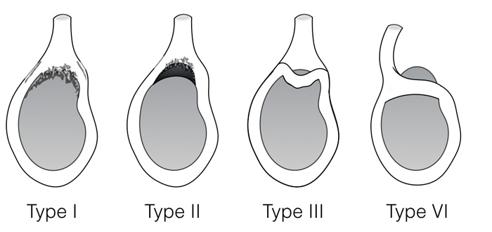 Types of SLAP tears Illustration