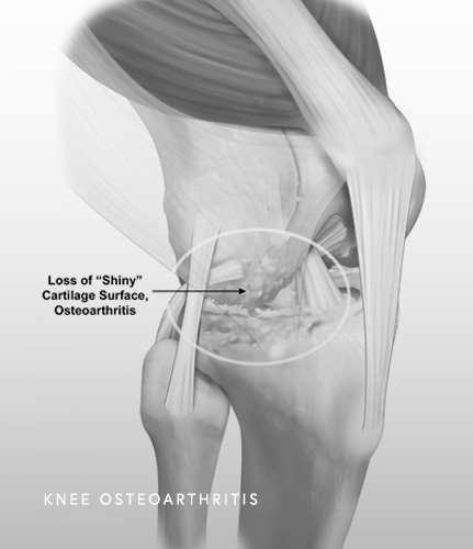 Image of Knee Osteoarthritis