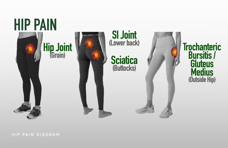 Hip Pain Location Chart Leg