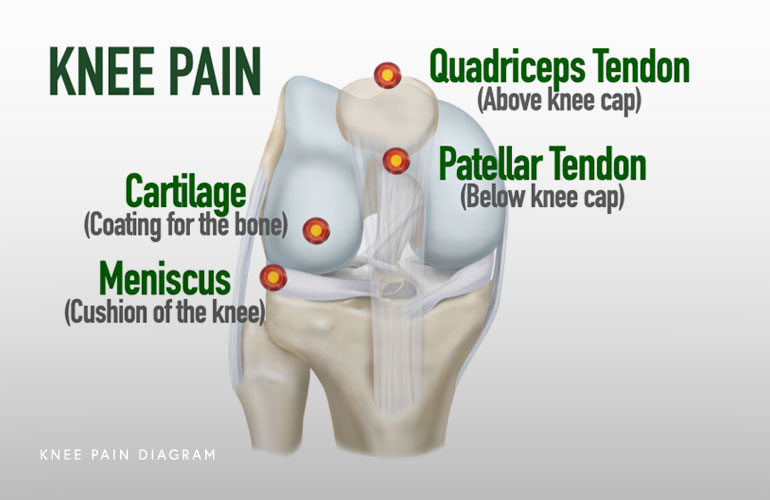 Knee Pain Diagram