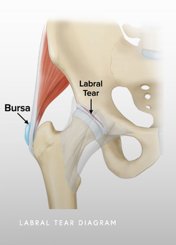 Labral Tear Diagram