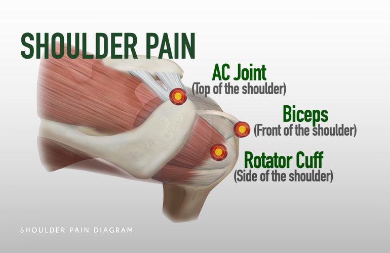 Shoulder Pain Diagram Illustration