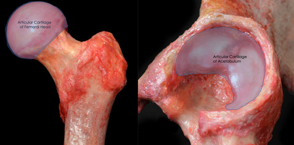 Photo of hip cartilage damage