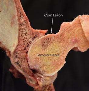 Cam Lesion and Femoral Head Photo