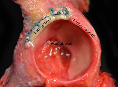 Photo of labral graft