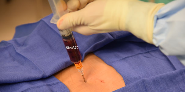 Photo of bone marrow aspirate concentrate injection