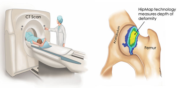 Illustration of hip deformity