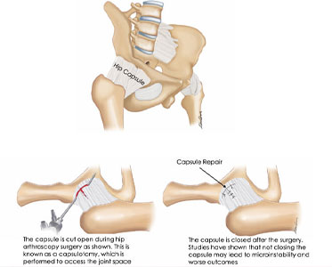 Diagram of capsular reconstruction