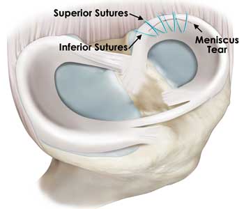 Illustration of a meniscal repair