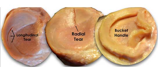 Image of the types of meniscus tears