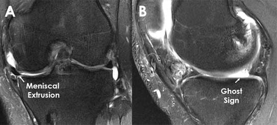 XRay of Meniscal Extrusion