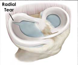 Illustration of a radial tear