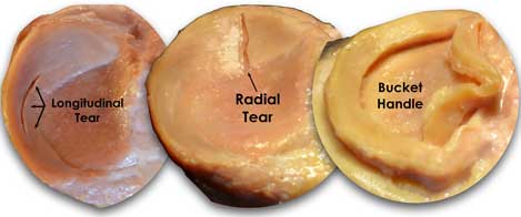 Image of the types of bucket handle tears