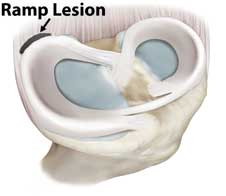 Illustration of a ramp lesion