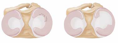 Illustration of a partial meniscectomy