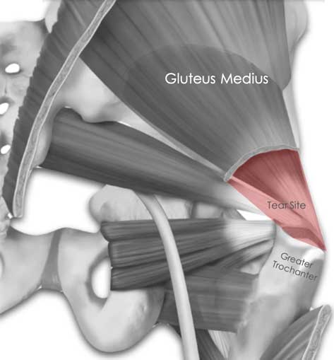 Illustration of a Gluteus Medius Tear