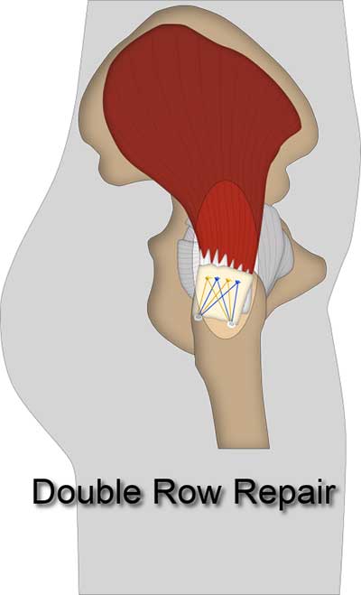 Illustration of a Double Row Repair