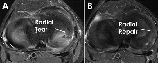 XRay of a Radial Tear and Radial Repair