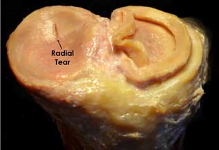 Image of a radial tear