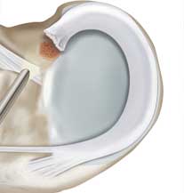 Illustration of meniscal roots