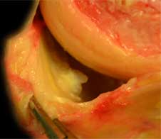 Photo of a ramp lesion