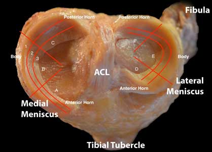 Diagram of an ACL and Tibial Tubercle